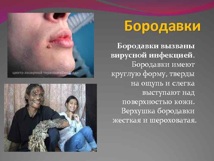 Бородавки вызваны вирусной инфекцией. Бородавки имеют круглую форму, тверды на ощупь и слегка выступают