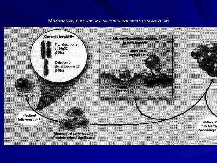 Механизмы прогрессии моноклональных гаммапатий 