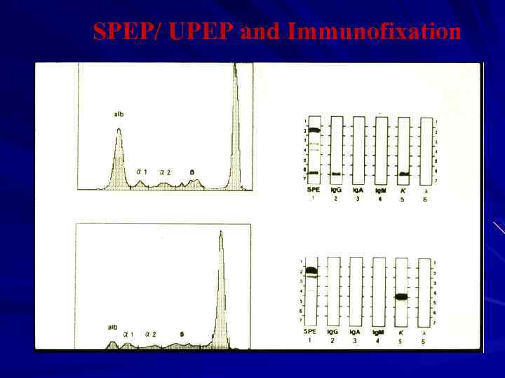 SPEP/ UPEP and Immunofixation SPEP Serum Immunofixation Urine Immunofixation UPEP 