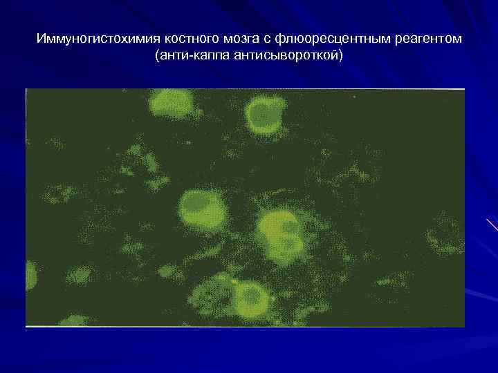 Иммуногистохимия костного мозга с флюоресцентным реагентом (анти-каппа антисывороткой) 