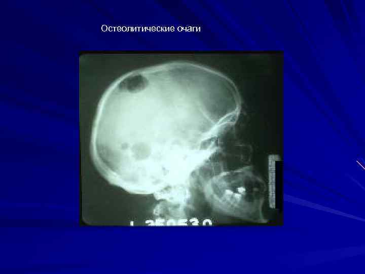 Остеолитические очаги 