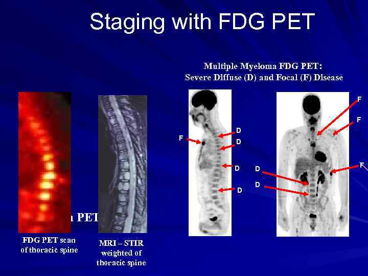 Staging with FDG PET Multiple Myeloma FDG PET: Severe Diffuse (D) and Focal (F)