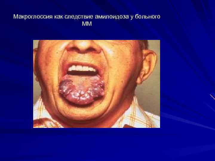 Макроглоссия как следствие амилоидоза у больного ММ 