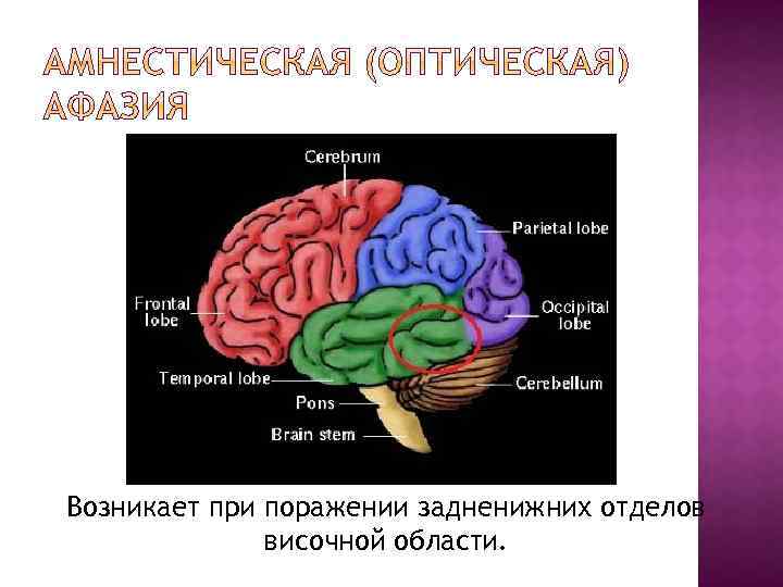 Возникает при поражении задненижних отделов височной области. 