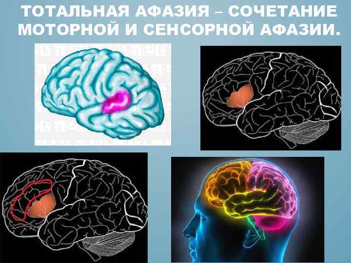 Афферентная моторная афазия симптомы