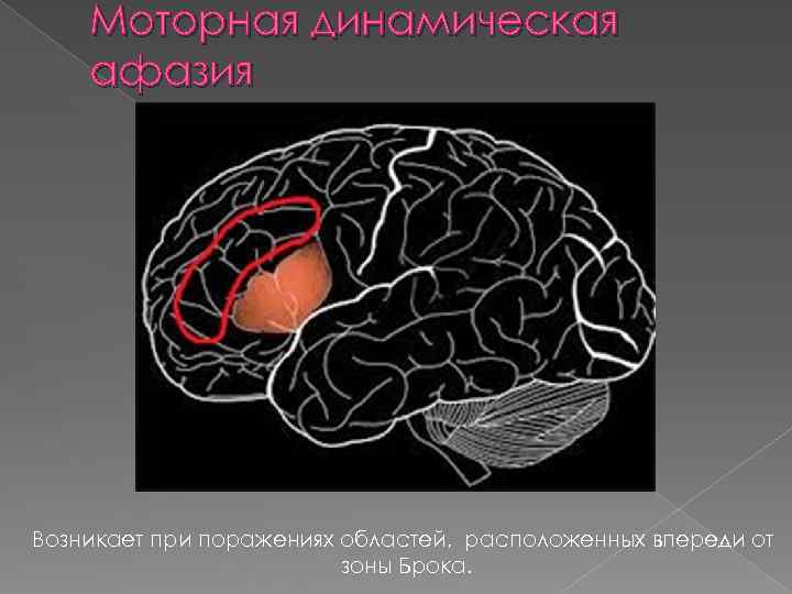 Динамическая афазия это моторная