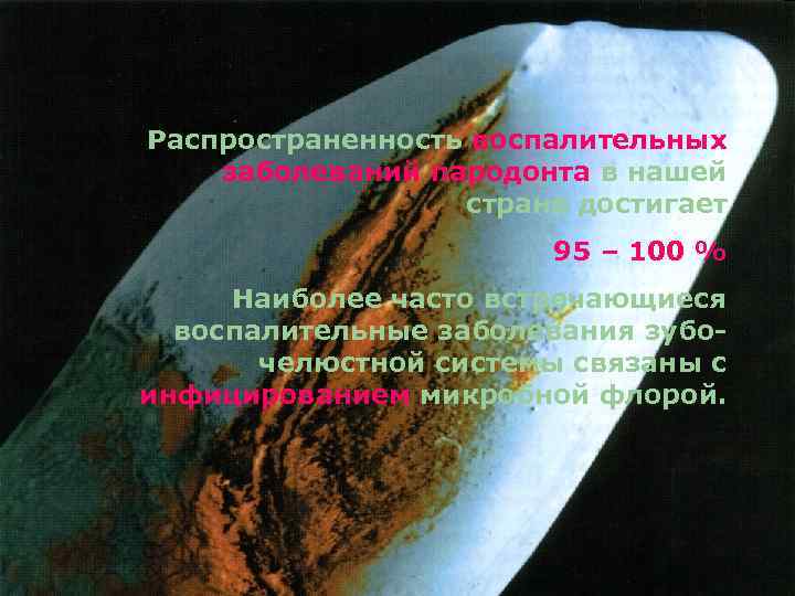 Распространенность воспалительных заболеваний пародонта в нашей стране достигает 95 – 100 % Наиболее часто