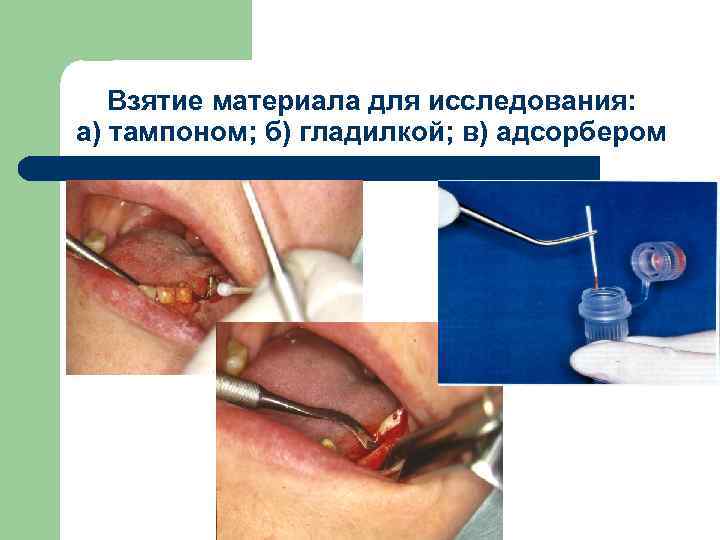 Взятие материала для исследования: а) тампоном; б) гладилкой; в) адсорбером 