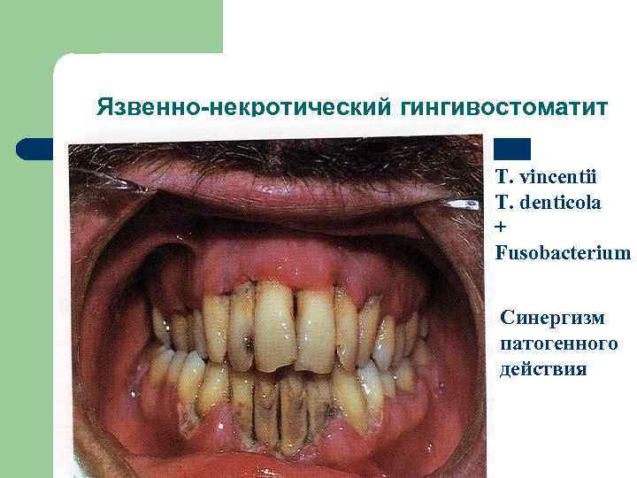 Язвенно-некротический гингивостоматит T. vincentii T. denticola + Fusobacterium Синергизм патогенного действия 