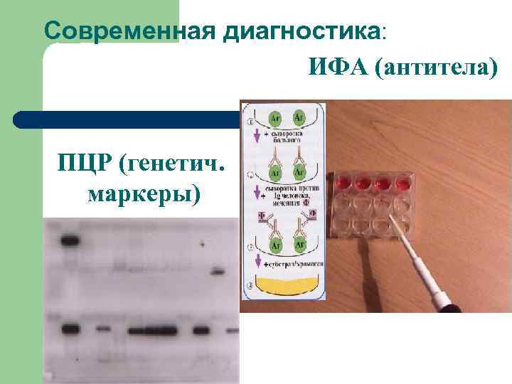 Современная диагностика: ИФА (антитела) ПЦР (генетич. маркеры) 
