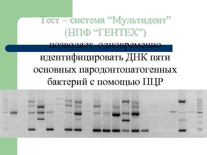 Тест – система “Мультидент” (НПФ “ГЕНТЕХ”) позволяет одновременно идентифицировать ДНК пяти основных пародонтопатогенных бактерий