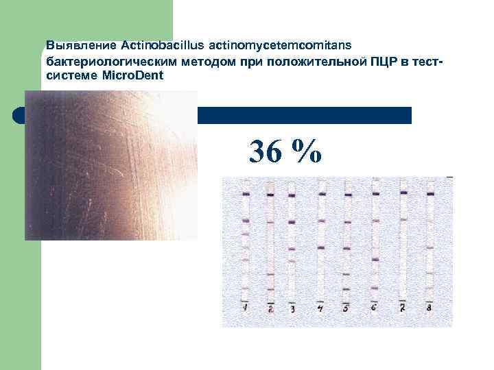 Выявление Actinobacillus actinomycetemcomitans бактериологическим методом при положительной ПЦР в тестсистеме Micro. Dent 36 %