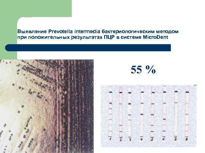 Выявление Prevotella intermedia бактериологическим методом при положительных результатах ПЦР в системе Micro. Dent 55