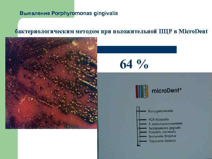 Выявление Porphyromonas gingivalis бактериологическим методом при положительной ПЦР в Micro. Dent 64 % 