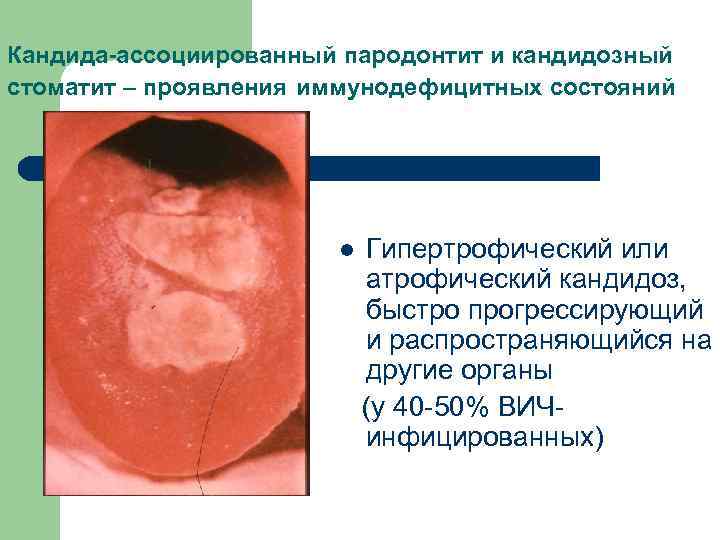 Кандида-ассоциированный пародонтит и кандидозный стоматит – проявления иммунодефицитных состояний l Гипертрофический или атрофический кандидоз,