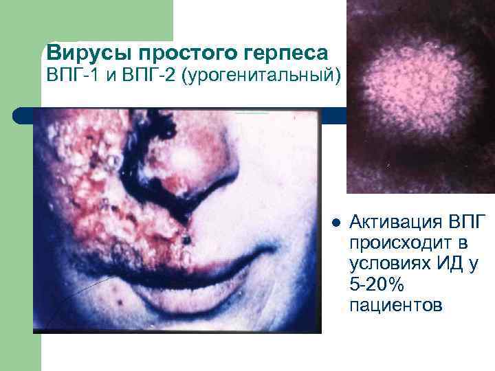 Вирусы простого герпеса ВПГ-1 и ВПГ-2 (урогенитальный) l Активация ВПГ происходит в условиях ИД
