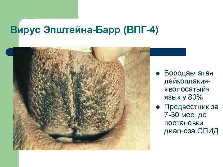 Вирус Эпштейна-Барр (ВПГ-4) l l Бородавчатая лейкоплакия «волосатый» язык у 80% Предвестник за 7