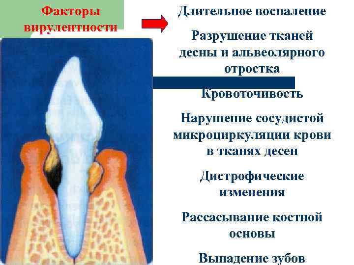 Факторы вирулентности Длительное воспаление Разрушение тканей десны и альвеолярного отростка Кровоточивость Нарушение сосудистой микроциркуляции