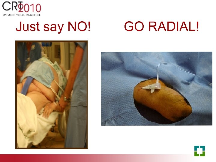 Just say NO! GO RADIAL! 