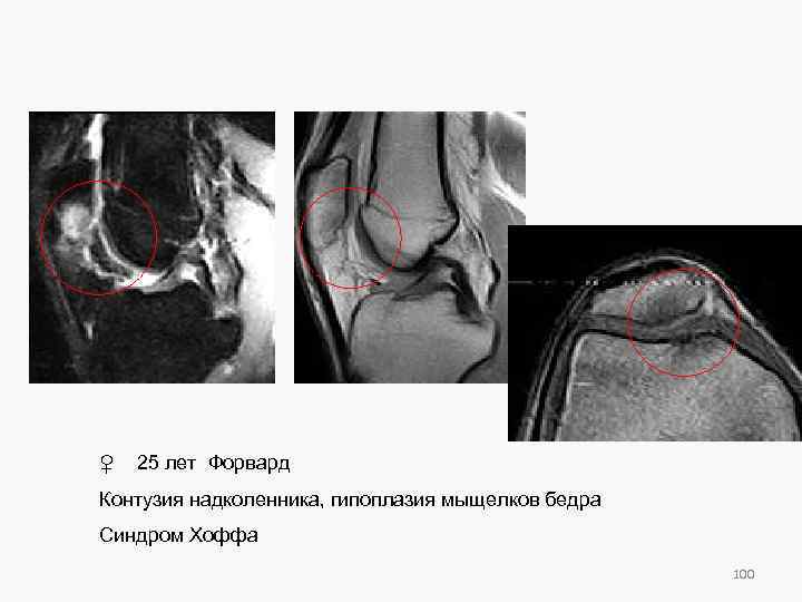 ♀ 25 лет Форвард Контузия надколенника, гипоплазия мыщелков бедра Синдром Хоффа 100 