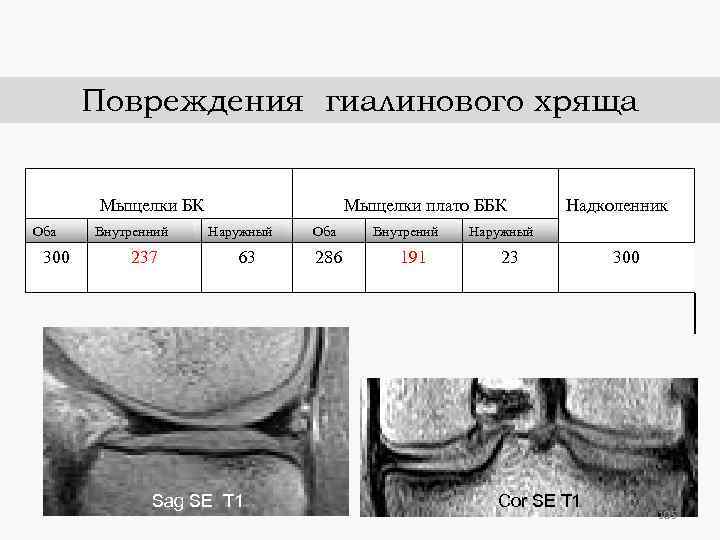 Повреждения гиалинового хряща Мыщелки БК Оба 300 Внутренний 237 Мыщелки плато ББК Наружный 63