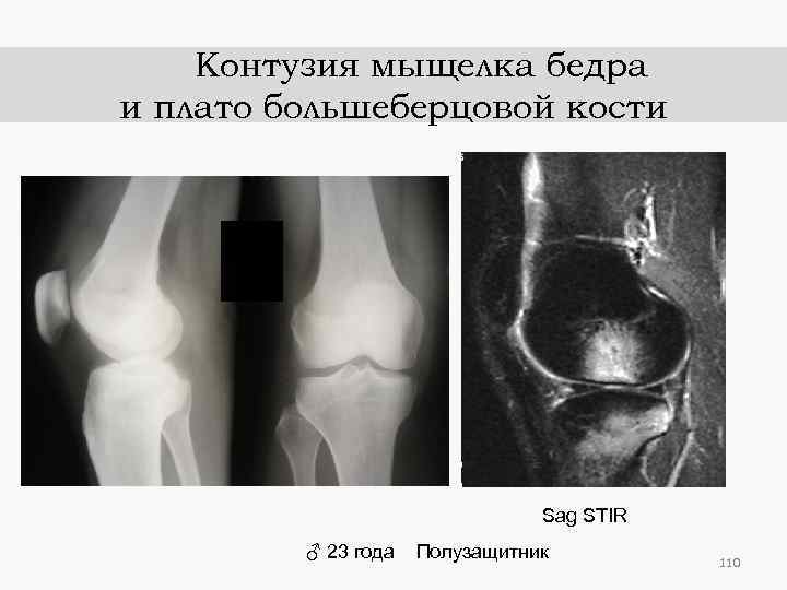 Контузия мыщелка бедра и плато большеберцовой кости Sag STIR ♂ 23 года Полузащитник 110