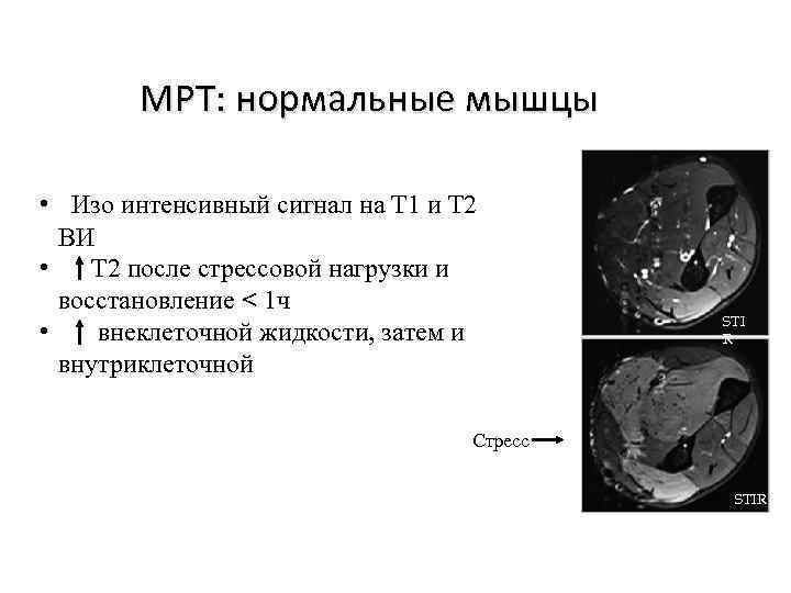 На т2 взвешенных изображениях при нативной магнитно резонансной томографии хорошо визуализируются