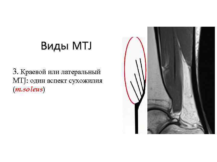 Виды MTJ 3. Краевой или латеральный MTJ: один аспект сухожилия (m. soleus) 