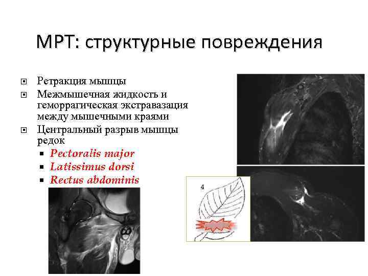 МРТ: структурные повреждения Ретракция мышцы Межмышечная жидкость и геморрагическая экстравазация между мышечными краями Центральный