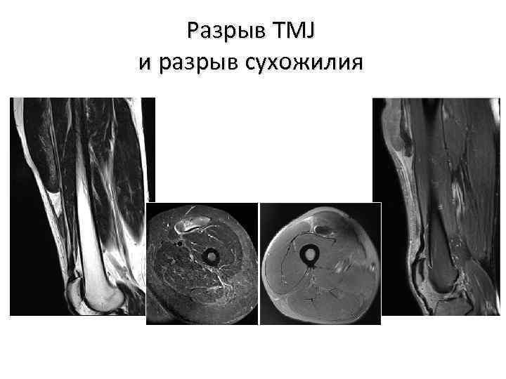 Разрыв TMJ и разрыв сухожилия 