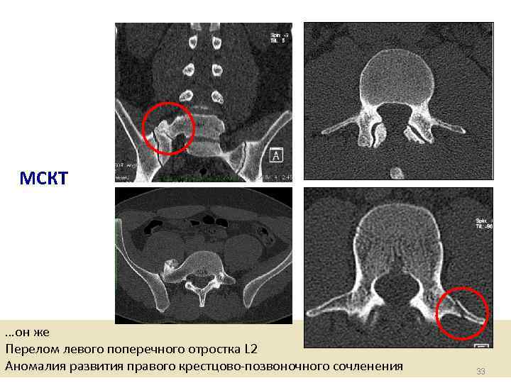 МСКТ …он же Перелом левого поперечного отростка L 2 Аномалия развития правого крестцово-позвоночного сочленения