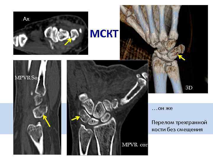 Ax МСКТ MPVR Sag 3 D …он же Перелом трехгранной кости без смещения MPVR