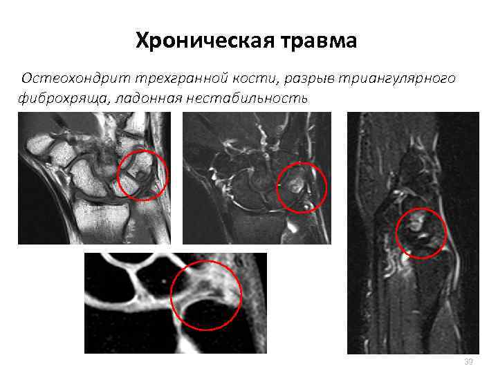 Хроническая травма Остеохондрит трехгранной кости, разрыв триангулярного фиброхряща, ладонная нестабильность 39 