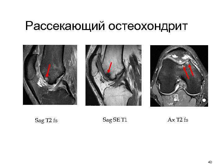 Рассекающий остеохондрит Sag T 2 fs Sag SE T 1 Ax T 2 fs