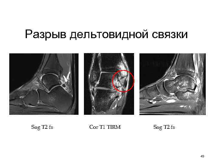 Разрыв дельтовидной связки Sag T 2 fs Cor T 1 TIRM Sag T 2