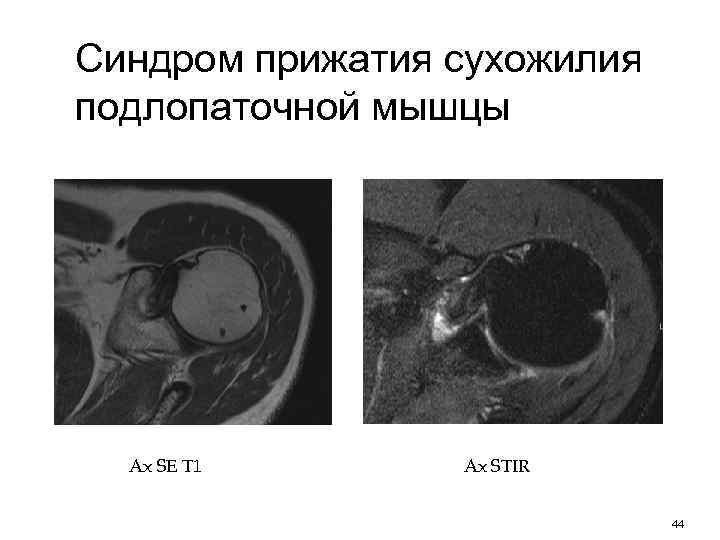 Синдром прижатия сухожилия подлопаточной мышцы Ax SE T 1 Ax STIR 44 