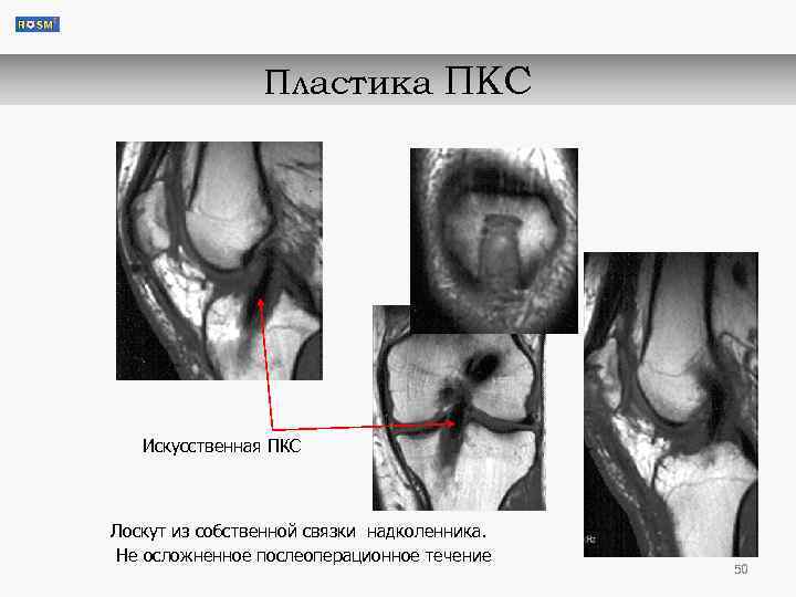 Пластика ПКС Искусственная ПКС Лоскут из собственной связки надколенника. Не осложненное послеоперационное течение 50