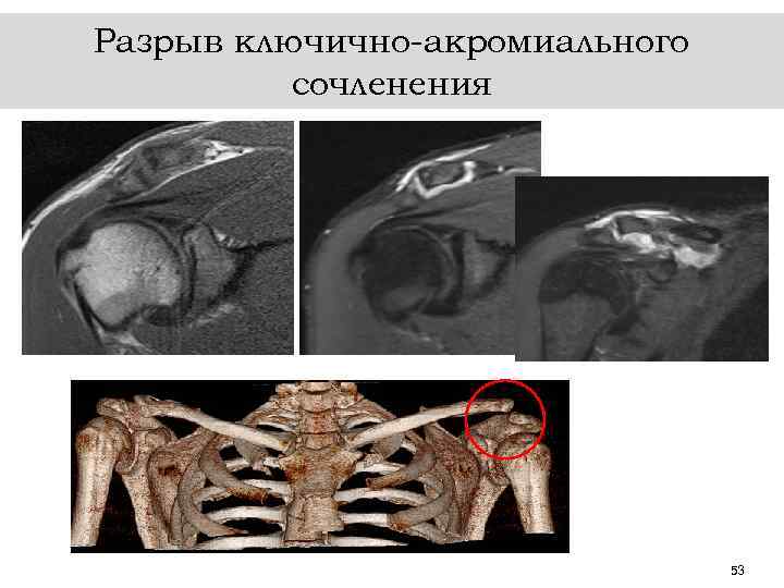 Разрыв ключично-акромиального сочленения 53 