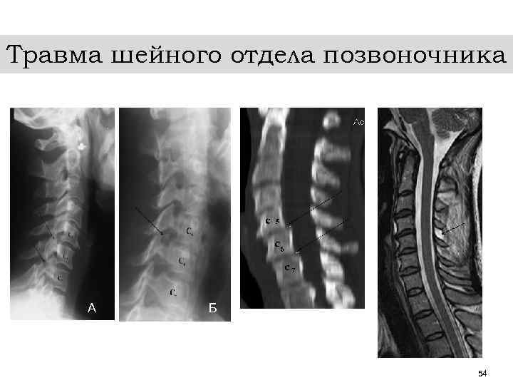 Травма шейного отдела позвоночника А Б 54 