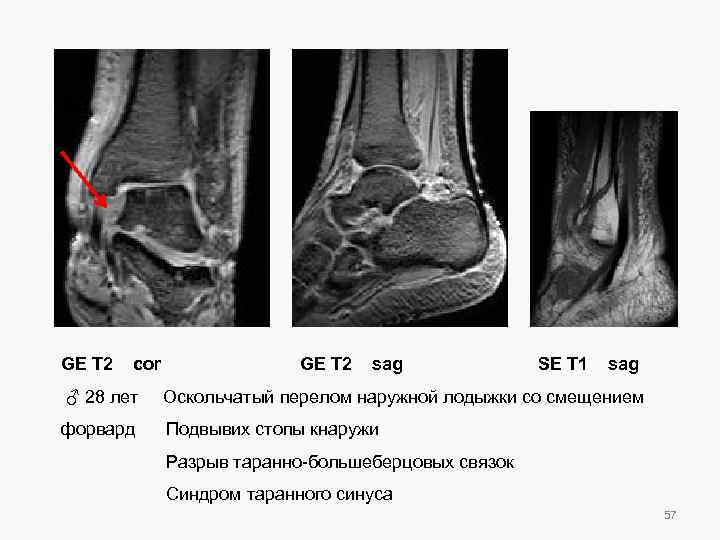 GE T 2 cor GE T 2 sag SE T 1 sag ♂ 28