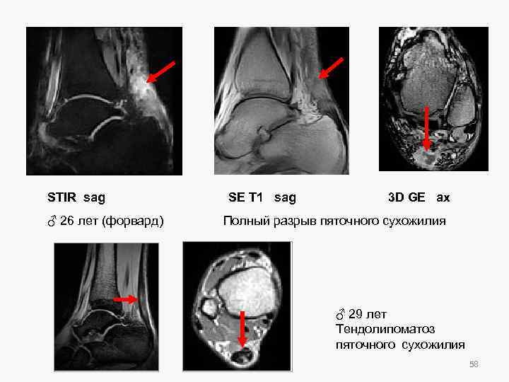 STIR sag ♂ 26 лет (форвард) SE T 1 sag 3 D GE ax