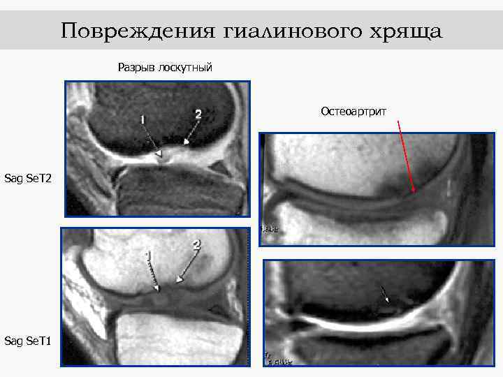 Повреждения гиалинового хряща Разрыв лоскутный Остеоартрит Sag Se. Т 2 Sag Se. Т 1