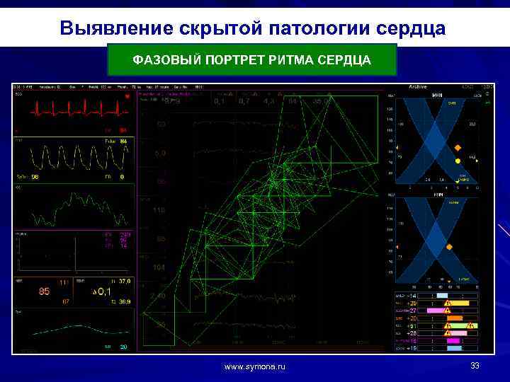 Выявление скрытой патологии сердца ФАЗОВЫЙ ПОРТРЕТ РИТМА СЕРДЦА www. symona. ru 33 