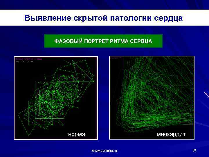 Выявление скрытой патологии сердца ФАЗОВЫЙ ПОРТРЕТ РИТМА СЕРДЦА миокардит норма www. symona. ru 34