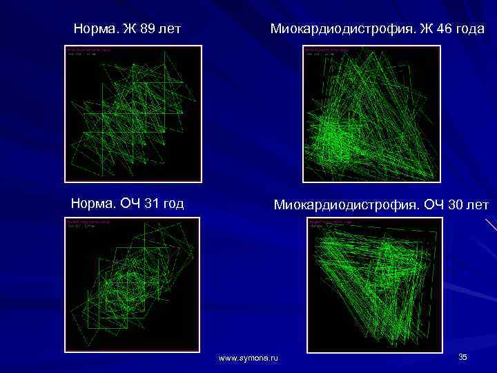 Норма. Ж 89 лет Миокардиодистрофия. Ж 46 года Норма. ОЧ 31 год Миокардиодистрофия. ОЧ
