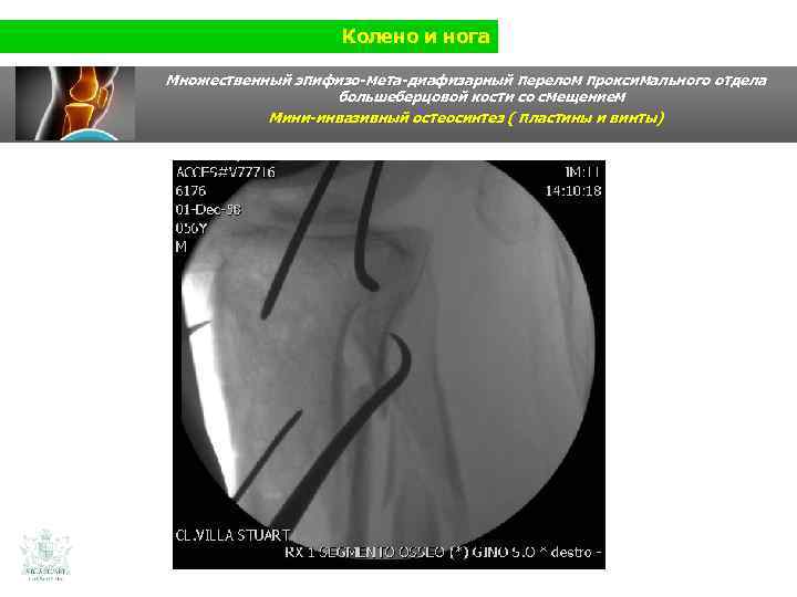 Колено и нога Множественный эпифизо-мета-диафизарный перелом проксимального отдела большеберцовой кости со смещением Мини-инвазивный остеосинтез