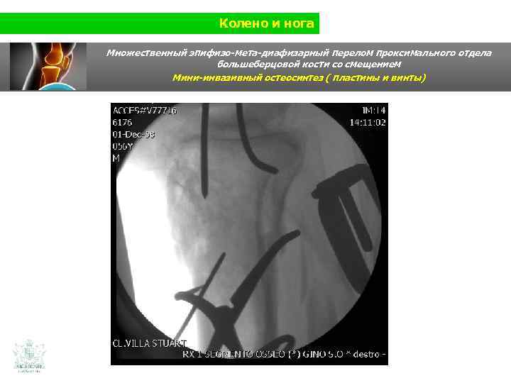 Колено и нога Множественный эпифизо-мета-диафизарный перелом проксимального отдела большеберцовой кости со смещением Мини-инвазивный остеосинтез