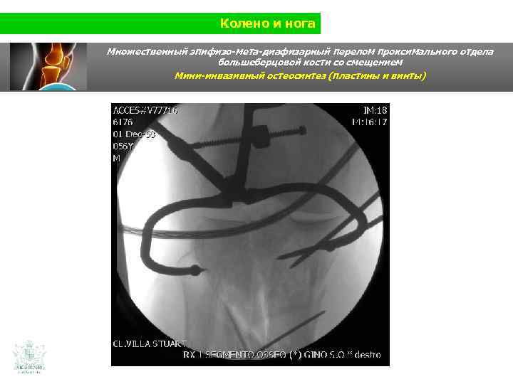 Колено и нога Множественный эпифизо-мета-диафизарный перелом проксимального отдела большеберцовой кости со смещением Мини-инвазивный остеосинтез