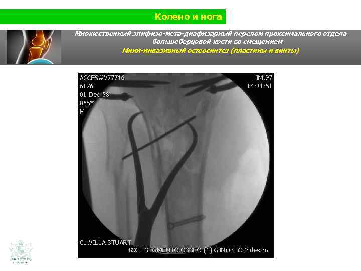 Колено и нога Множественный эпифизо-мета-диафизарный перелом проксимального отдела большеберцовой кости со смещением Мини-инвазивный остеосинтез