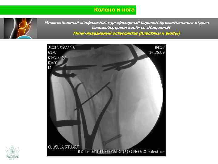 Колено и нога Множественный эпифизо-мета-диафизарный перелом проксимального отдела большеберцовой кости со смещением Мини-инвазивный остеосинтез